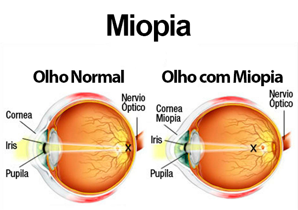 Principais causas da miopia